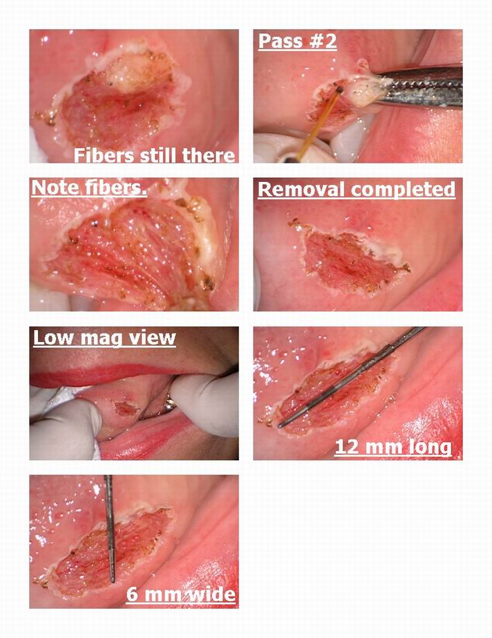 Fibroma removal pg 2.jpg
